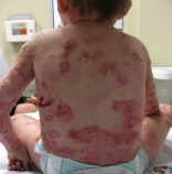 epidermolisis-bullosa