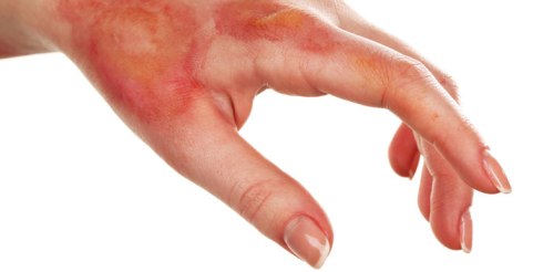 curar-una-quemadura-cuando-se-tiene-diabetes